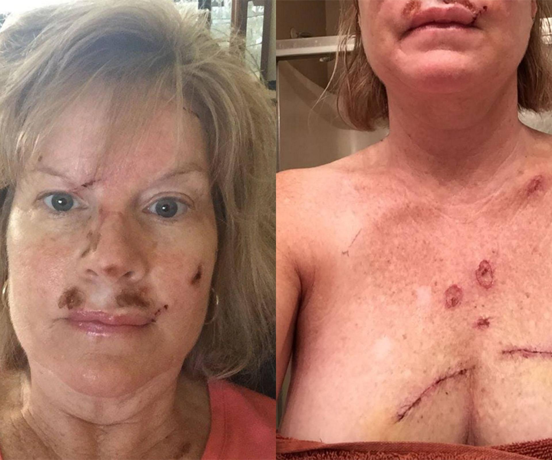 ‘This could be you’: Woman shares shocking skin cancer selfies
