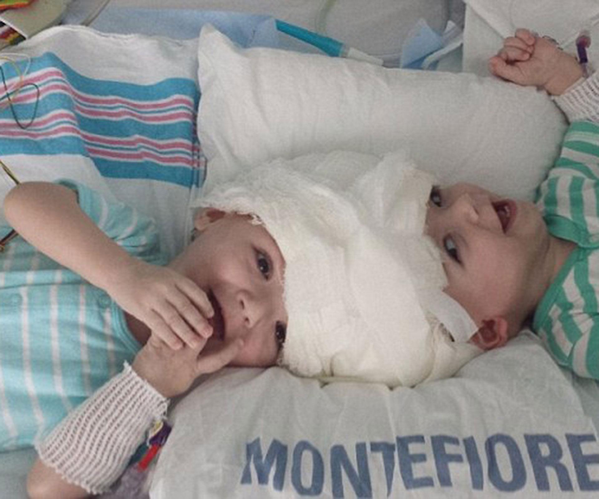Beautiful moment conjoined twins see each other for the first time since they were separated