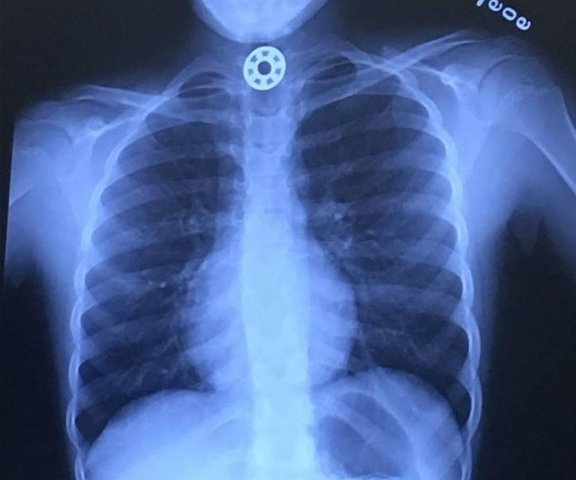 Fidget Spinner choking warning after part gets stuck in girl’s throat