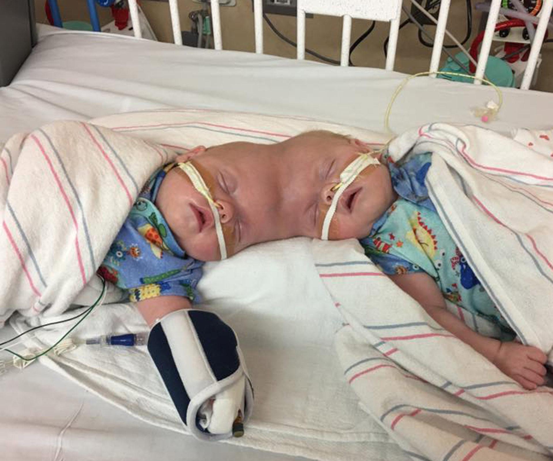 Delaney Twins conjoined at head separated before turning one
