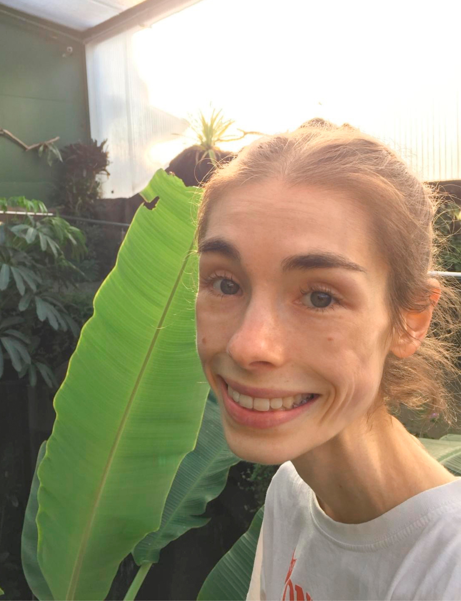 Millie Hardiman at her sickest - a mere 26kgs in weight.