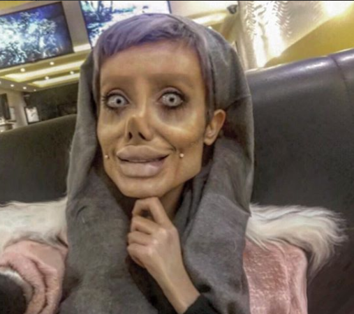 Iranian teenager has 50 surgeries to ‘look like Angelina Jolie’