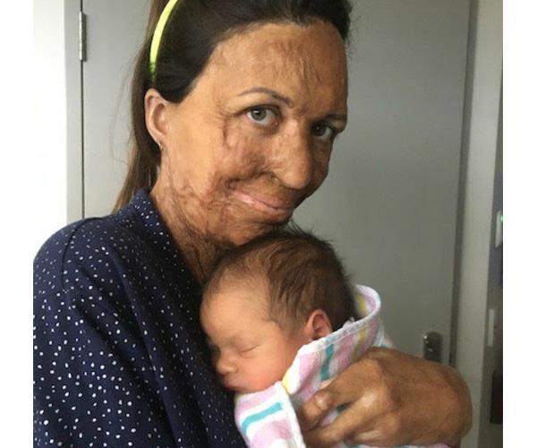 Australian burns survivor Turia Pitt gives birth to a baby boy