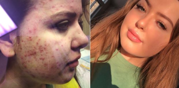 Teenager shares how she got rid of severe acne – and her tweet goes viral