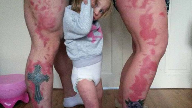 Parents get tattoos to match daughter’s birthmark